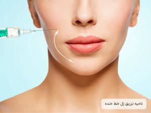 تصویر مرتبط با تزریق فیلر